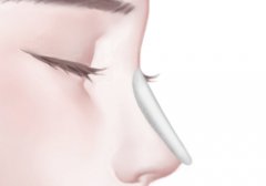 塌鼻子的成功人士有嗎？隆鼻多少錢(qián)？美鼻攻略必看！